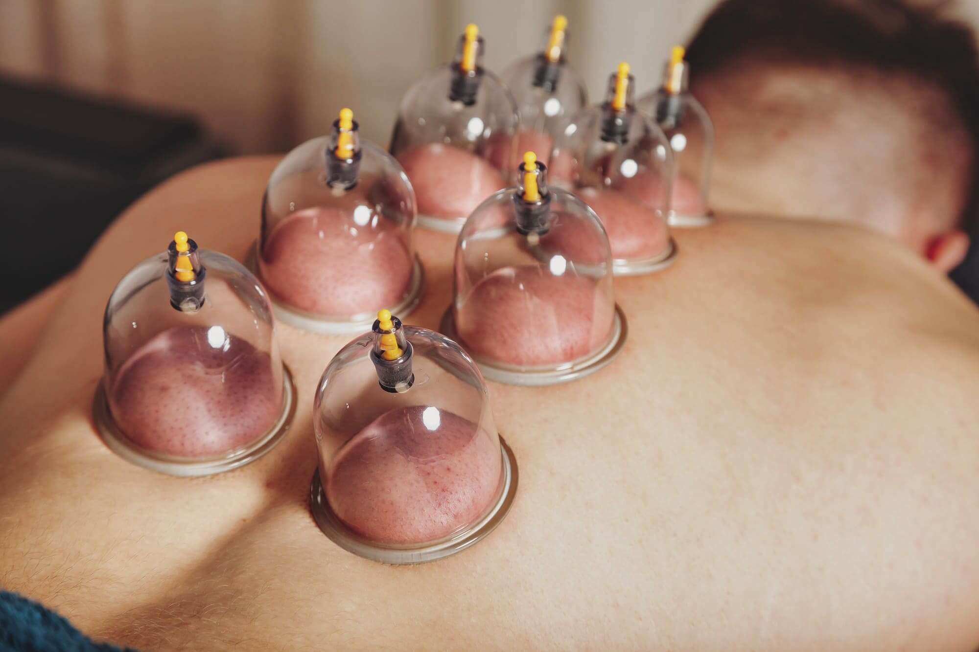 cupping therapy- hihama