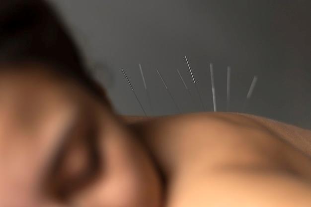 acupuncture for back and neck pain
