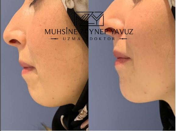 Chin filler treatment - enhancing facial features with dermal fillers
