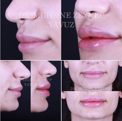 Enhancing lips with lip filler treatment - achieving fuller and more defined lips