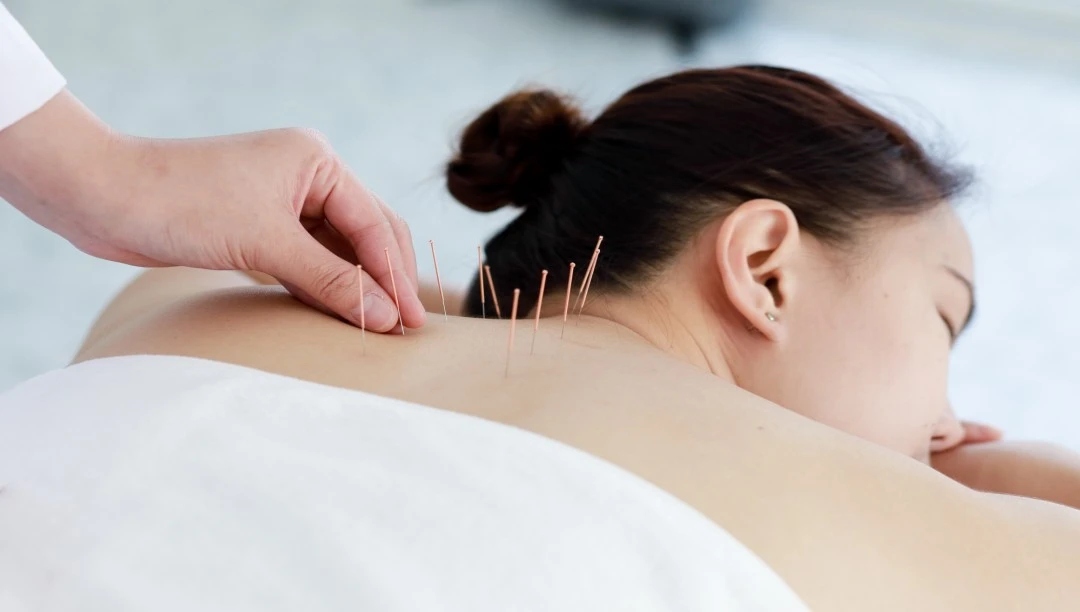 Akupunktur nedir? Akupunktur ile zayıflama, Akupunktur fiyatları? İstanbul
